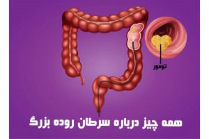 سرطان روده بزرگ چیست ؟ دلایل ابتلا, علائم و روش های درمان سرطان کلورکتال